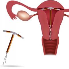 Внутрішньоматкова спіраль: чим хороший і поганий цей метод контрацепції